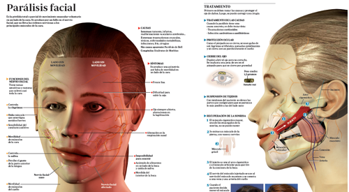 ¿La parálisis facial está producida por razones psicológicas?
